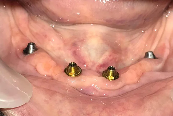 Full Mouth Rehabilitation
