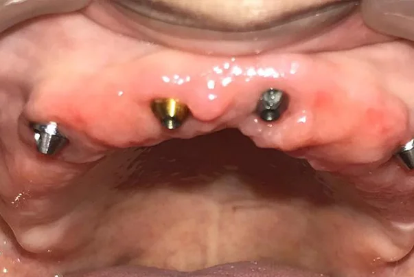 Full Mouth Rehabilitation