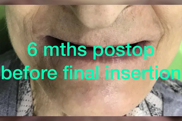 Full Mouth Rehabilitation