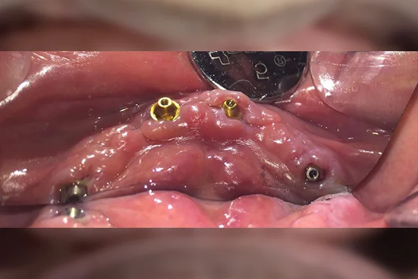 Full Mouth Rehabilitation