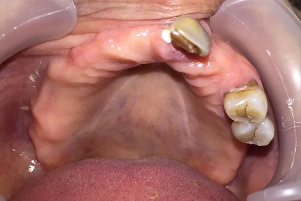 Full Mouth Rehabilitation