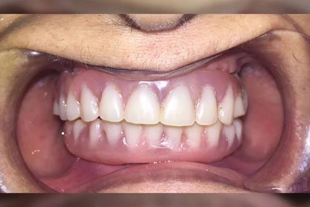 Full Mouth Rehabilitation