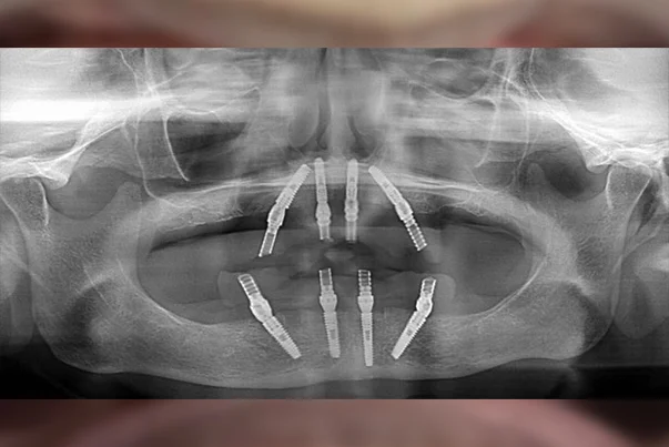 Full Mouth Rehabilitation