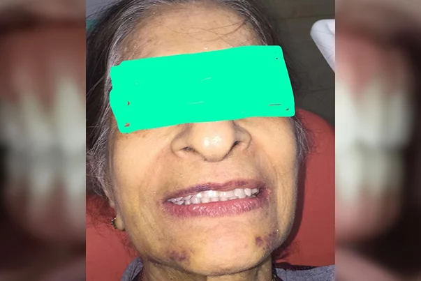 Full Mouth Rehabilitation