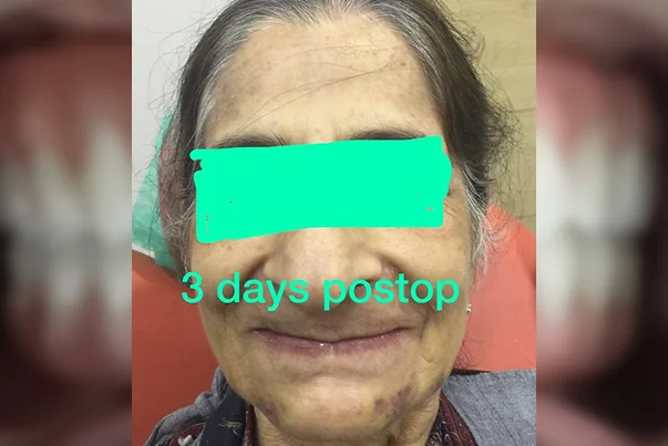 Full Mouth Rehabilitation