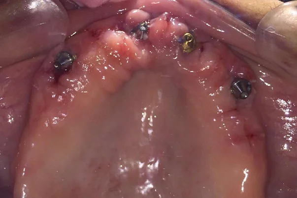 Full Mouth Rehabilitation