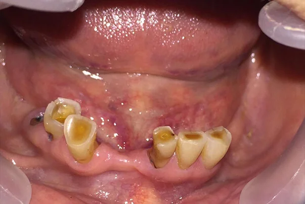 Full Mouth Rehabilitation