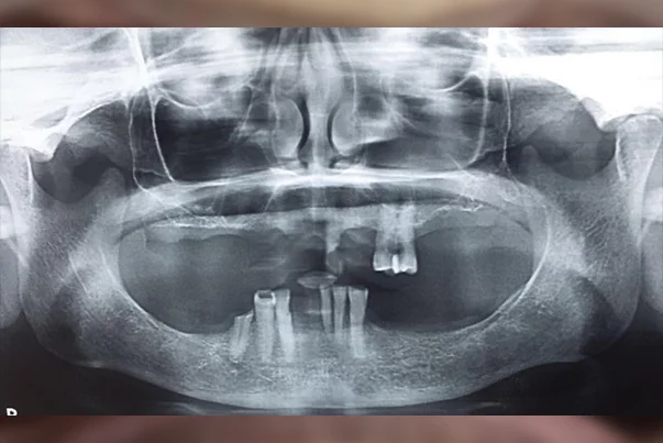 Full Mouth Rehabilitation
