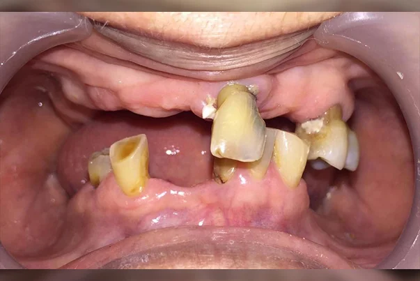 Full Mouth Rehabilitation