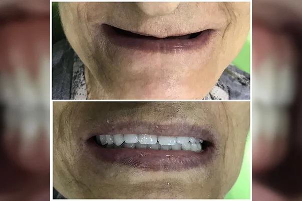Full Mouth Rehabilitation