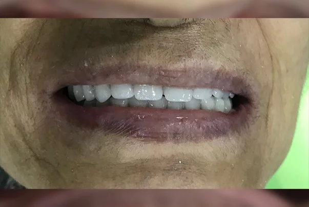 Full Mouth Rehabilitation