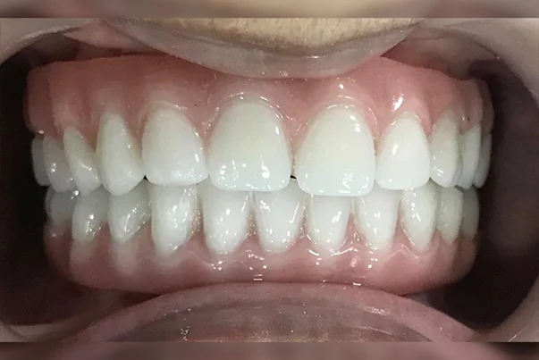 Full Mouth Rehabilitation