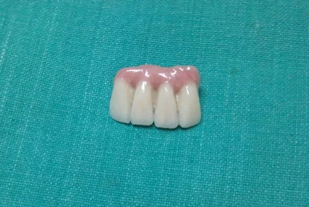 Hybrid Prosthesis For Aesthetic Area