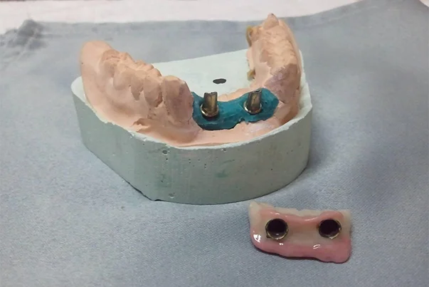 Hybrid Prosthesis For Aesthetic Area