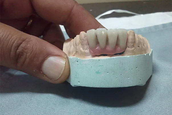 Hybrid Prosthesis For Aesthetic Area