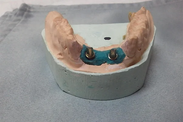 Hybrid Prosthesis For Aesthetic Area
