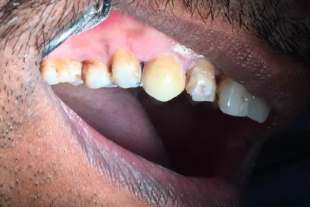 Metal Free Crown