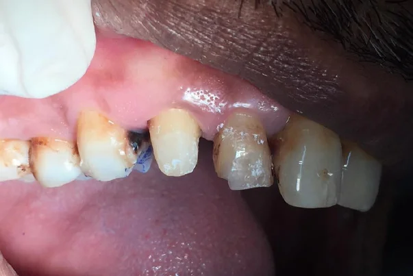 Metal Free Crown