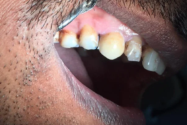 Metal Free Crown