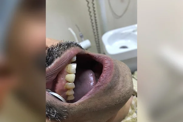 Single Tooth Implant Replacement