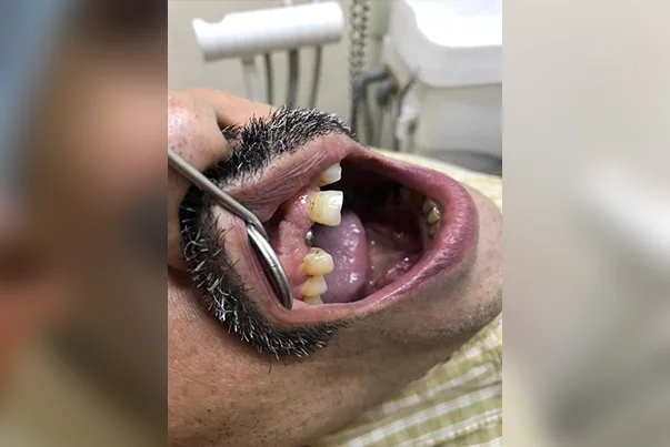Single Tooth Implant Replacement