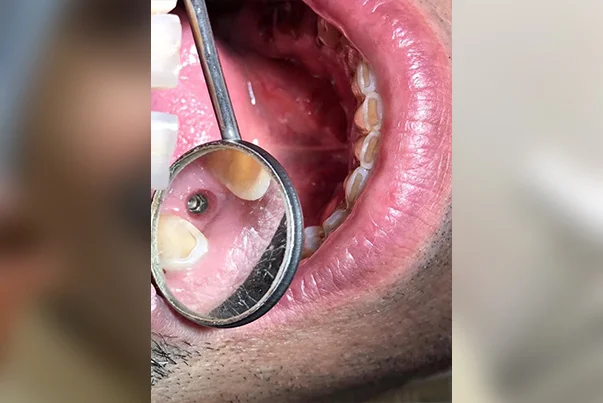 Single Tooth Implant Replacement