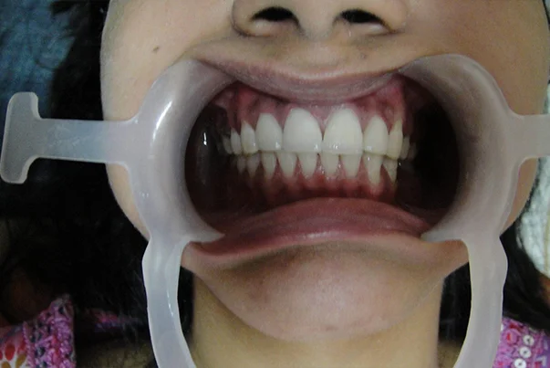 Smile Design With Veneers
