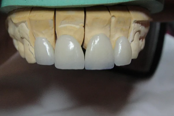 Smile Design With Veneers