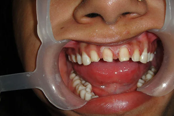 Smile Design With Veneers