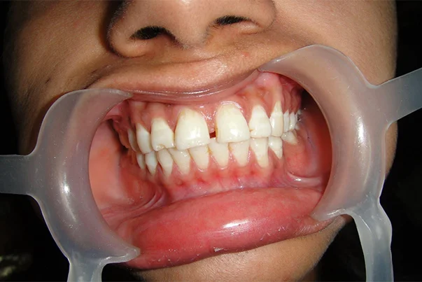 Smile Design With Veneers