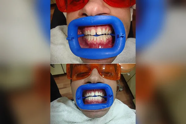 Zoom Bleaching Instant Whitening