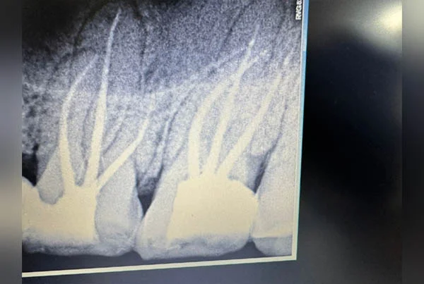 Single Sitting RCT