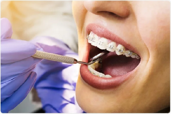 Dental Braces Fixing