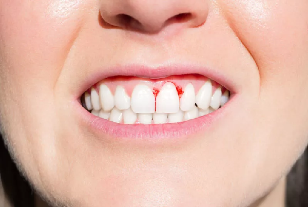 Gum Disease Treatment