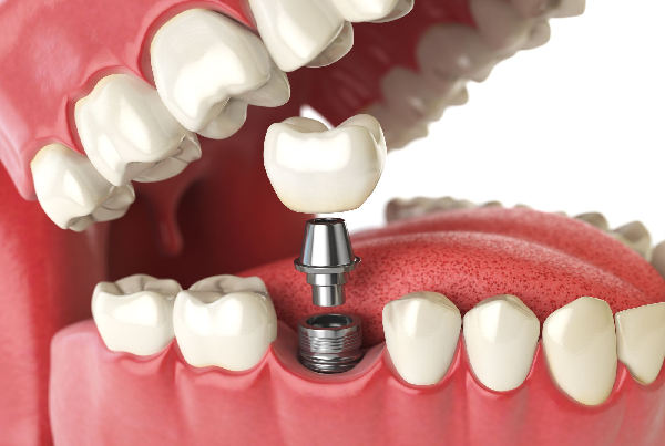 Dental Implant Fixing