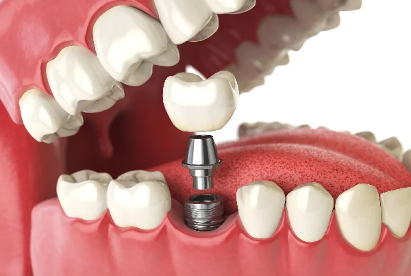 Dental Implant Fixing