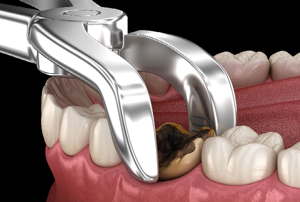 Impacted Tooth Extraction