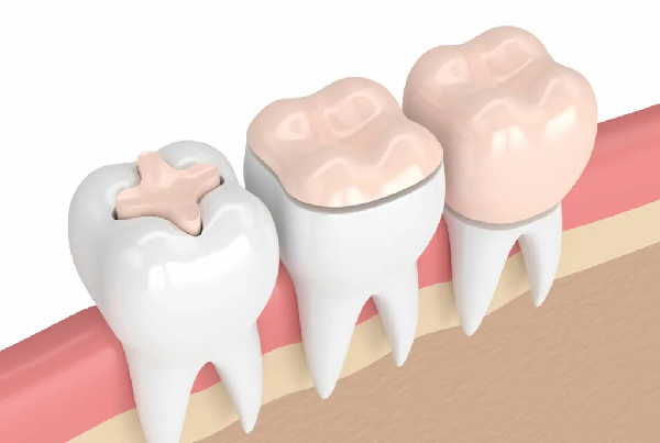 Dental Restoration